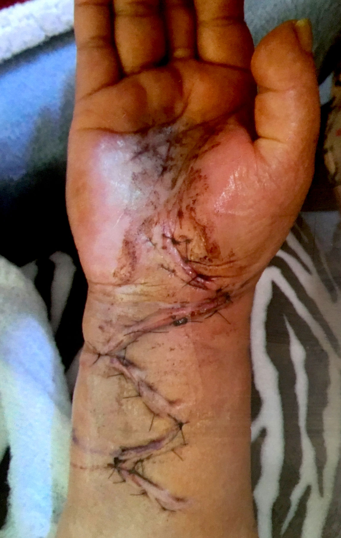 Meatpacking injuries
